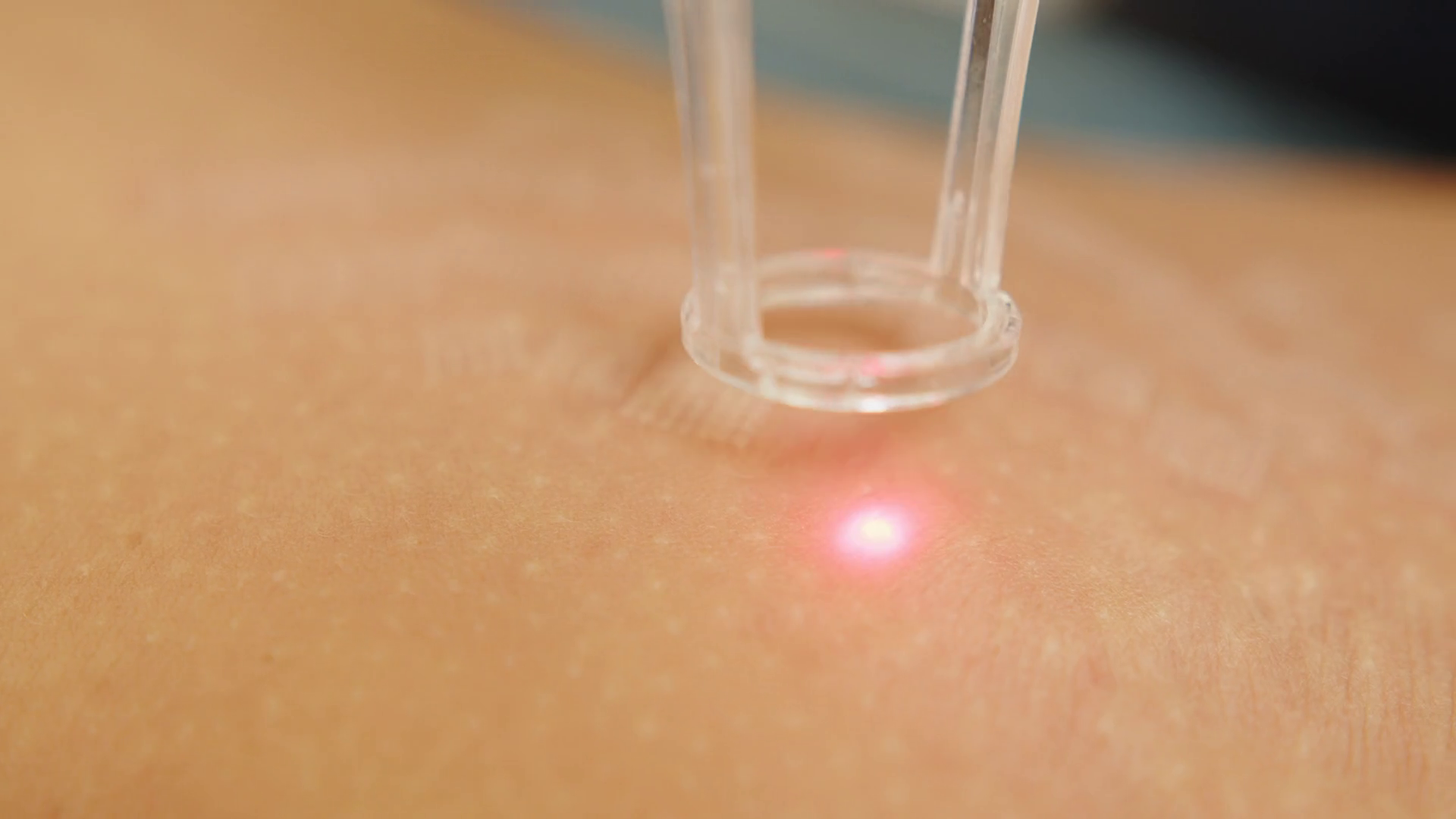 Expert Advice on Skin Tag Removal in Bradford